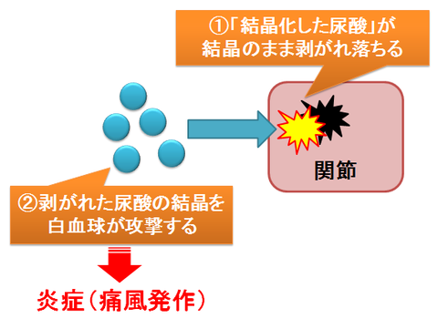 結晶離脱説～尿酸と痛風発作