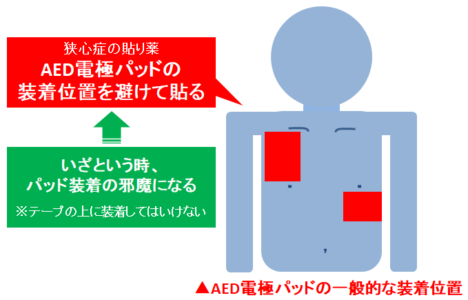 波紋 有料 悪因子 ニトロ グリセリン テープ 貼り 方 - itcomp.jp