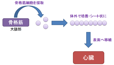 ハートシートの移植